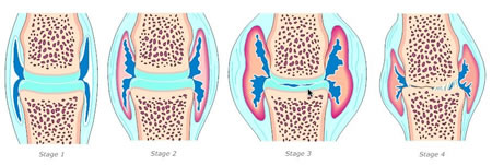 Stages of Arthritis